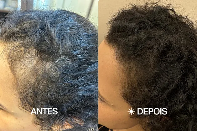 Mariana S. — Rarefação na região frontal — antes e depois do acompanhamento no The Jazz