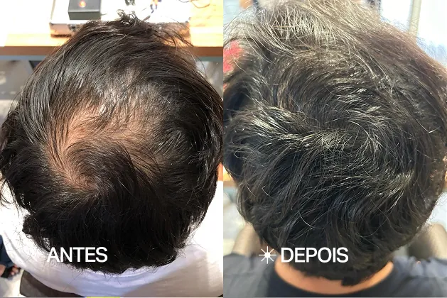 Carlos T. — Perda de densidade — antes e depois do acompanhamento no The Jazz