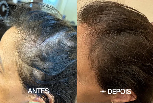 Sandra P. — Recessão lateral — antes e depois do acompanhamento no The Jazz