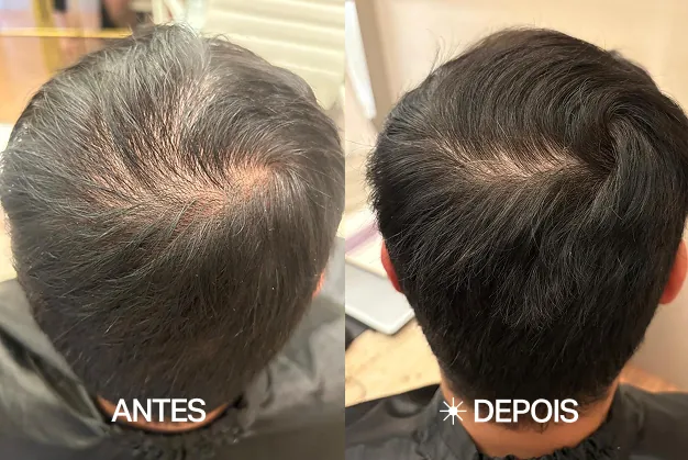 Ricardo M. — Afinamento na coroa — antes e depois do acompanhamento no The Jazz